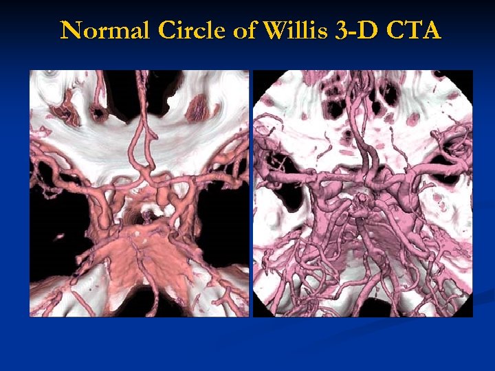 Normal Circle of Willis 3 -D CTA 