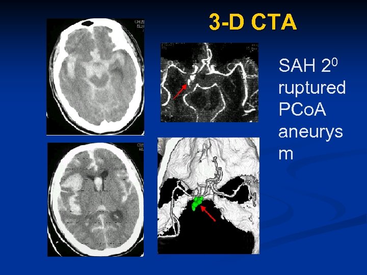3 -D CTA SAH 20 ruptured PCo. A aneurys m 