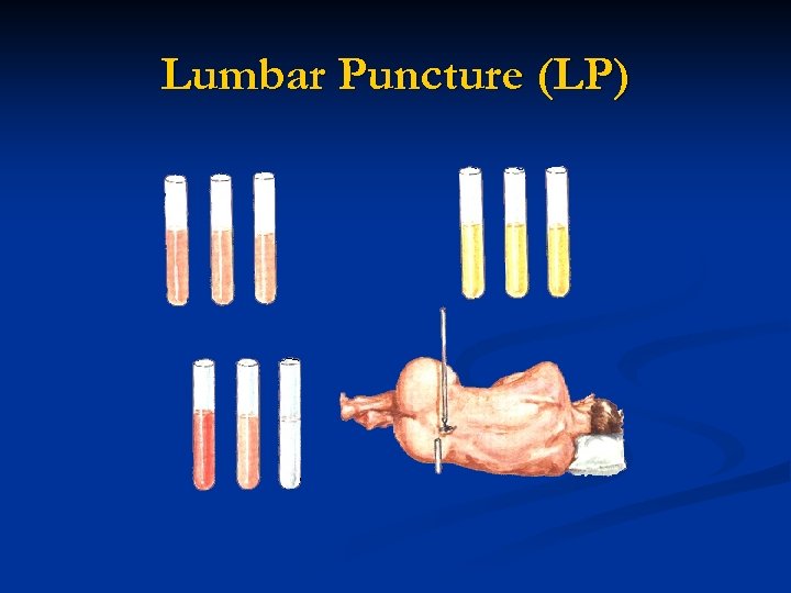 Lumbar Puncture (LP) 