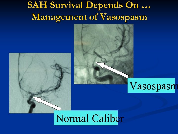 SAH Survival Depends On … Management of Vasospasm Normal Caliber 