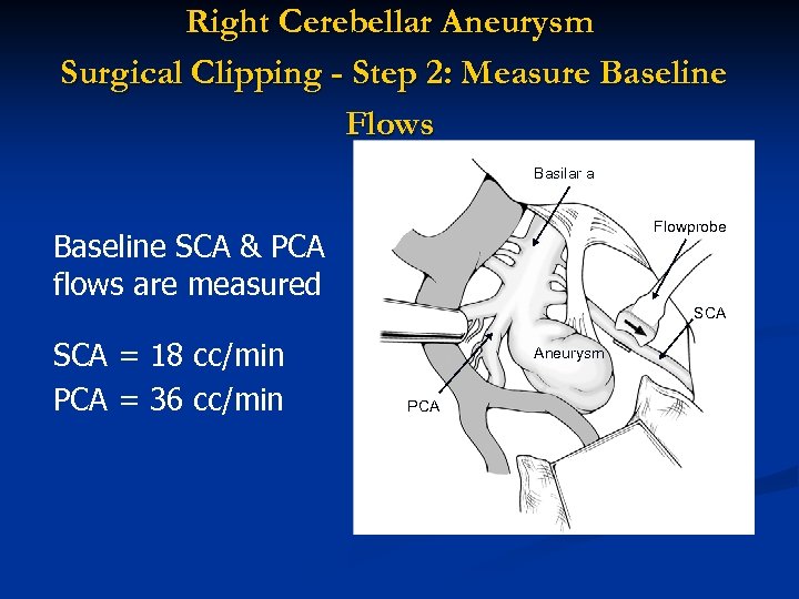 Right Cerebellar Aneurysm Surgical Clipping - Step 2: Measure Baseline Flows Basilar a Flowprobe