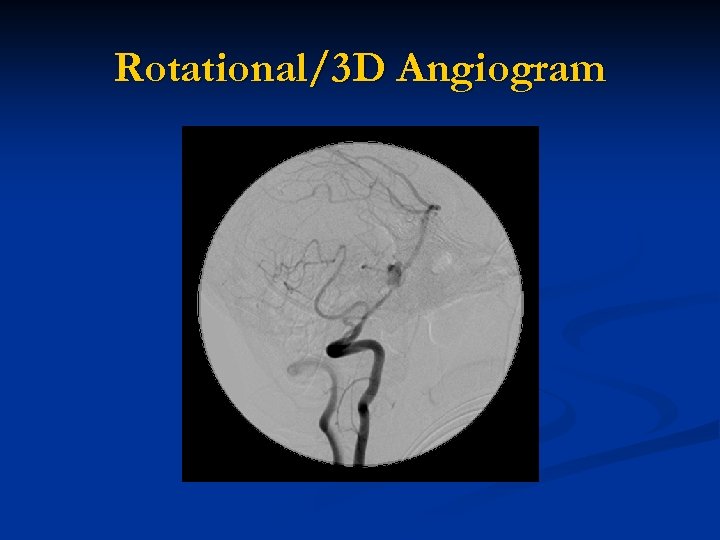 Rotational/3 D Angiogram 