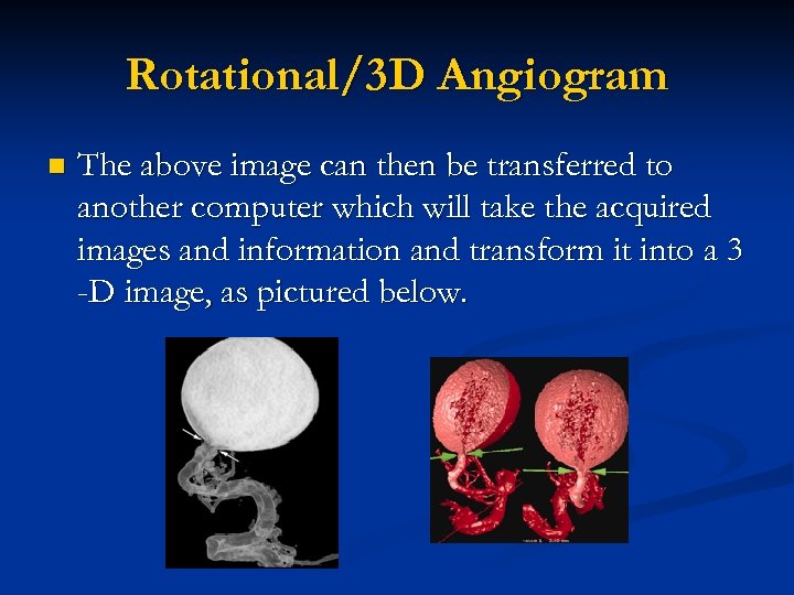 Rotational/3 D Angiogram n The above image can then be transferred to another computer