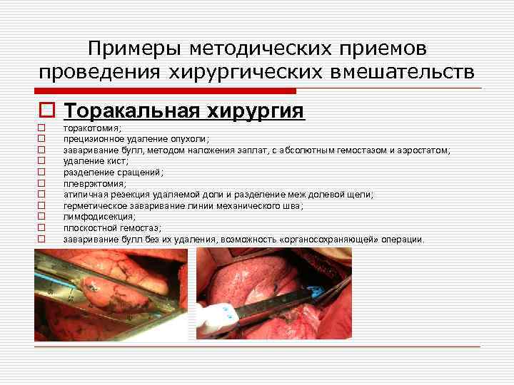 Примеры методических приемов проведения хирургических вмешательств o Торакальная хирургия o o o торакотомия; прецизионное
