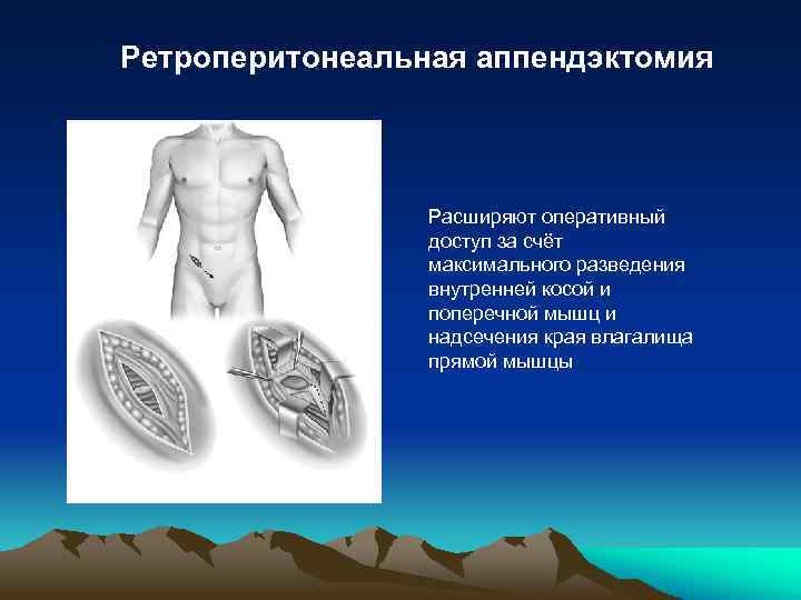 Ретроперитонеальная аппендэктомия Расширяют оперативный доступ за счёт максимального разведения внутренней косой и поперечной мышц