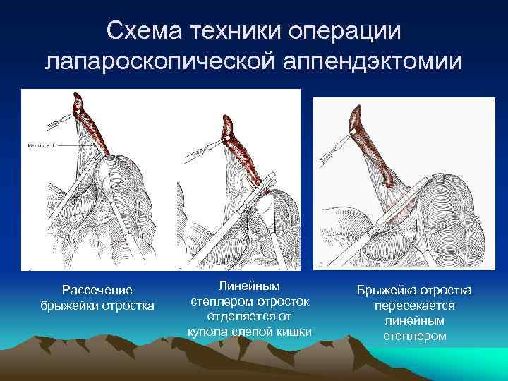 Место где болит при аппендиците на картинке