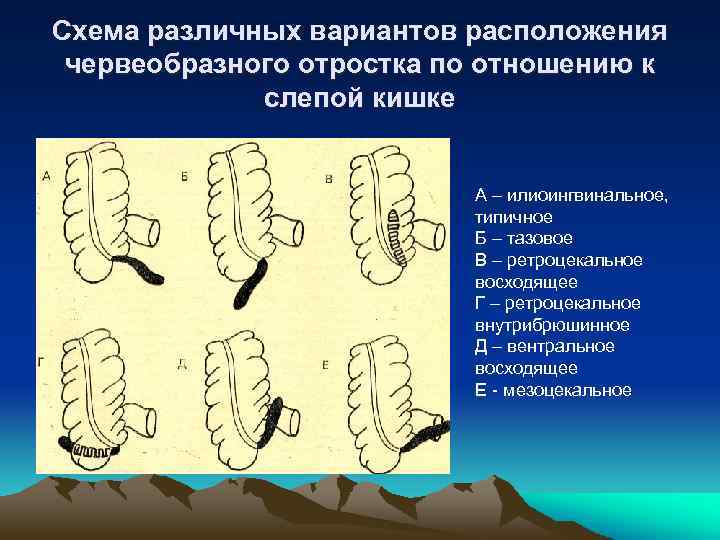 Варианты аппендикса. Расположение червеобразного отростка. Варианты расположения червеобразного отростка схема. Расположение червеобразного отростка по отношению к слепой кишке. Атипичное расположение аппендикса.