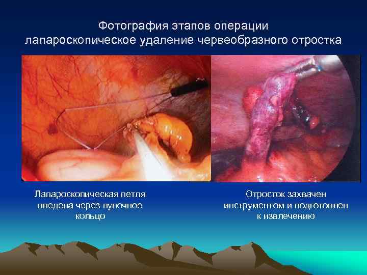 Фотография этапов операции лапароскопическое удаление червеобразного отростка Лапароскопическая петля введена через пупочное кольцо Отросток
