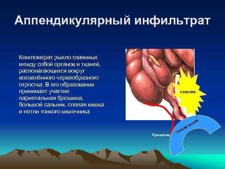 У больного с четко отграниченным аппендикулярным инфильтратом на фоне значительного