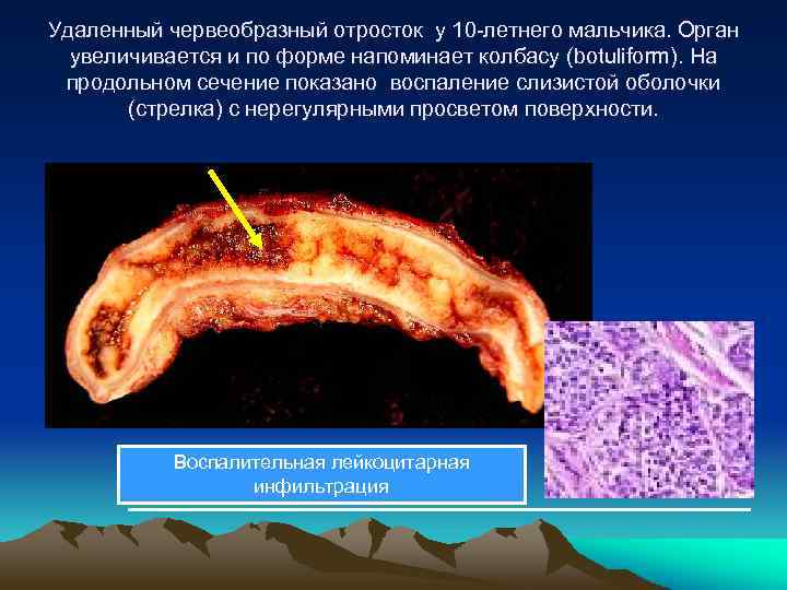 Удаленный червеобразный отросток у 10 -летнего мальчика. Орган увеличивается и по форме напоминает колбасу