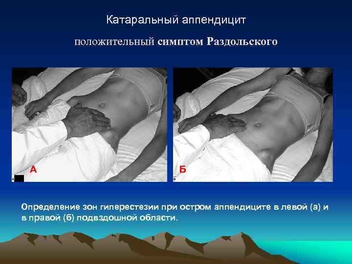 Катаральный аппендицит положительный симптом Раздольского А Б Определение зон гиперестезии при остром аппендиците в