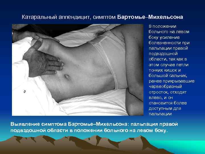  Катаральный аппендицит, симптом Бартомье–Михельсона В положении больного на левом боку усиление болезненности при