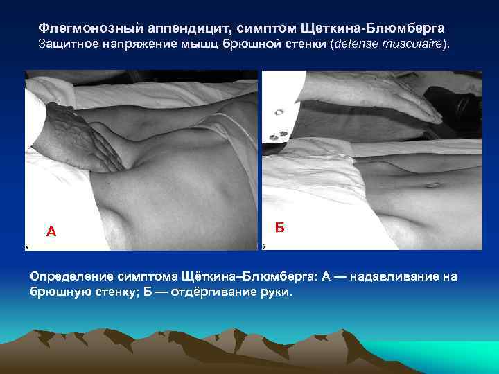 Флегмонозный аппендицит, симптом Щеткина-Блюмберга Защитное напряжение мышц брюшной стенки (defense musculaire). А Б Определение