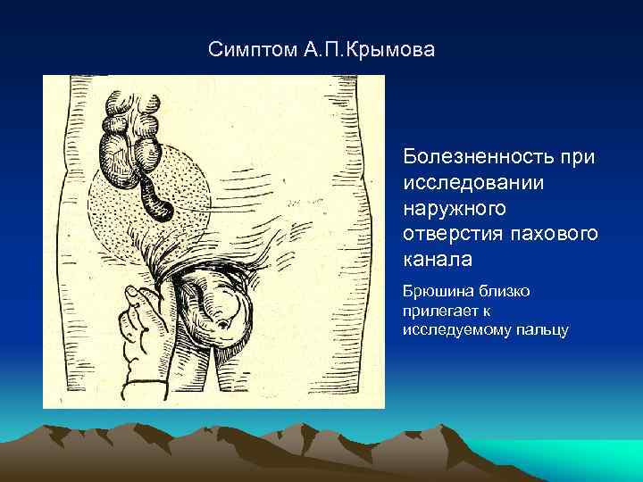 Симптом А. П. Крымова Болезненность при исследовании наружного отверстия пахового канала Брюшина близко прилегает