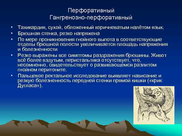 Перфоративный Гангренозно-перфоративный • Тахикардия, сухой, обложенный коричневатым налётом язык. • Брюшная стенка, резко напряжена