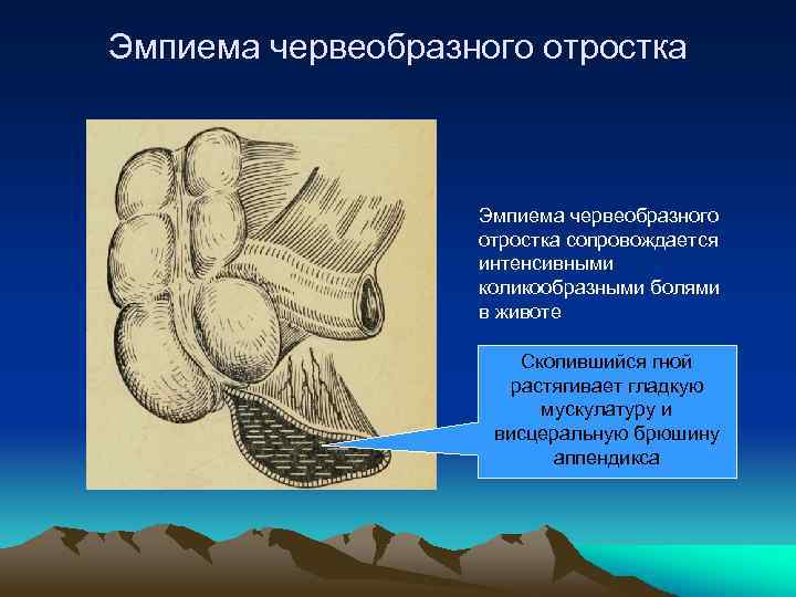 B клинической картине острого аппендицита c развитием деструкции червеобразного отростка