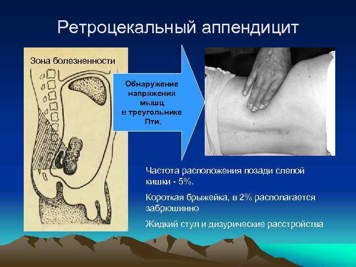 Ретроцекальный аппендицит Зона болезненности Обнаружение напряжения мышц в треугольнике Пти. Частота расположения позади слепой