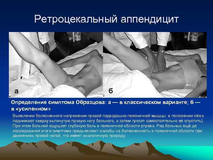 Ретроцекальный аппендицит а б Определение симптома Образцова: а — в классическом варианте; б —