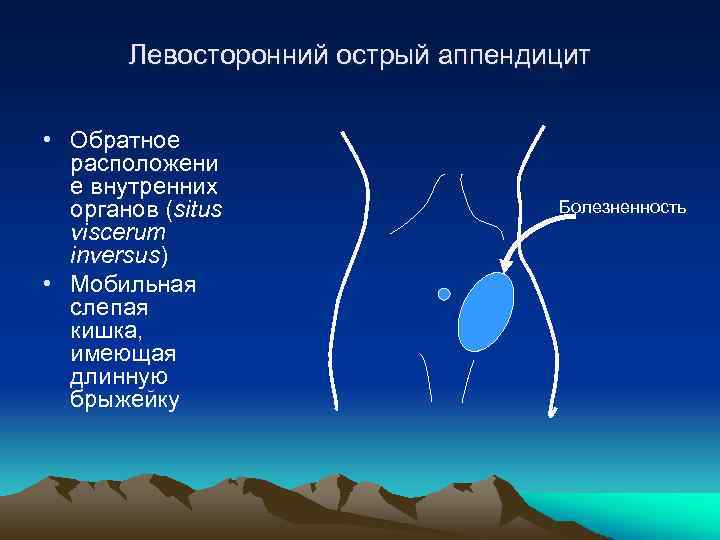Левосторонний острый аппендицит • Обратное расположени е внутренних органов (situs viscerum inversus) • Мобильная