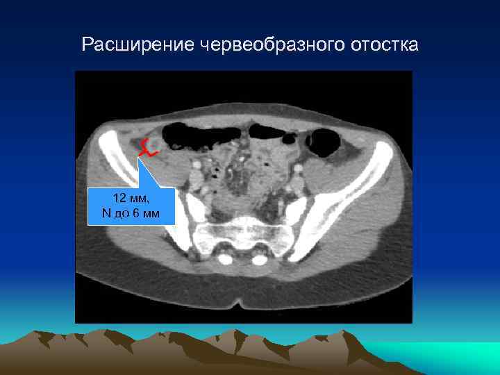 Расширение червеобразного отостка 12 мм, N до 6 мм 