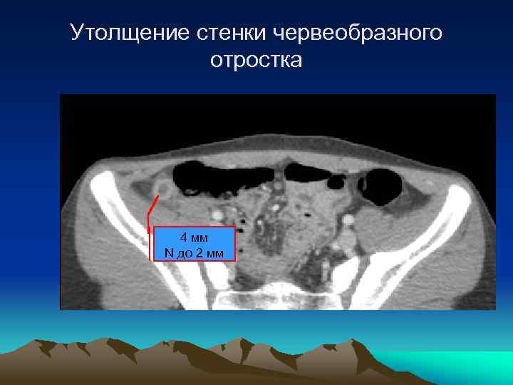 Утолщение стенки червеобразного отростка 4 мм N до 2 мм 