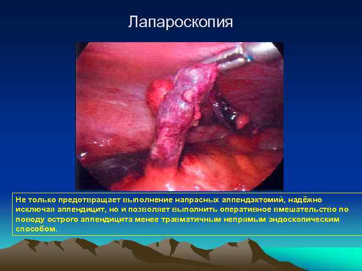 Лапароскопия Не только предотвращает выполнение напрасных аппендэктомий, надёжно исключая аппендицит, но и позволяет выполнить