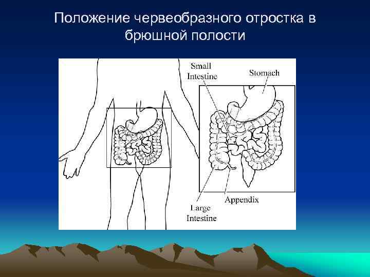 Положение червеобразного отростка в брюшной полости 