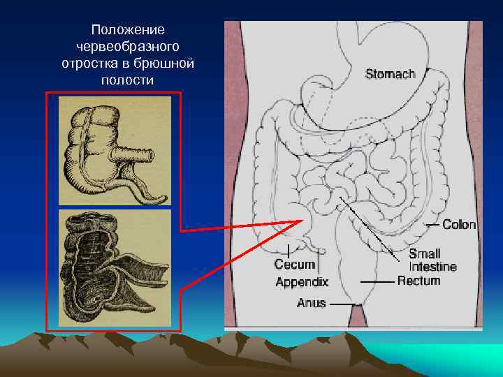 Особенности клинической картины острого аппендицита при тазовом расположении червеобразного отростка