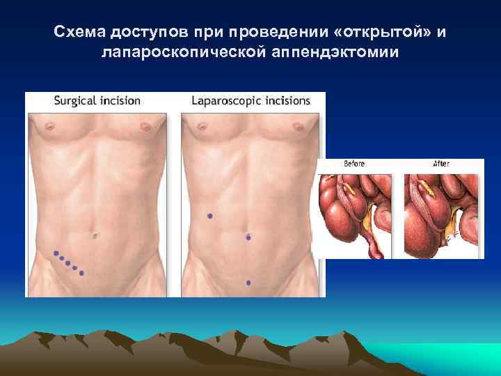 Схема доступов при проведении «открытой» и лапароскопической аппендэктомии 