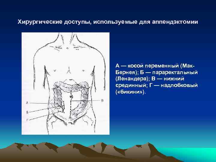 При типичной картине острого аппендицита операционным доступом является