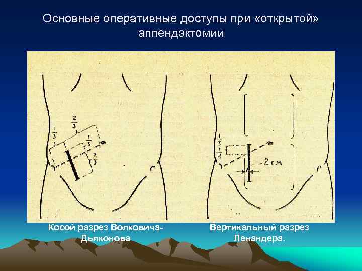 Симптом кохера волковича