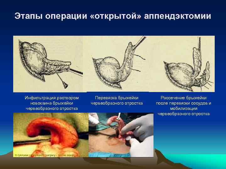 Этапы операции «открытой» аппендэктомии Инфильтрация раствором новокаина брыжейки червеобразного отростка Перевязка брыжейки червеобразного отростка