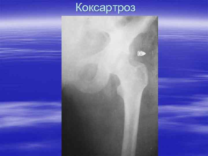 Коксартроз 