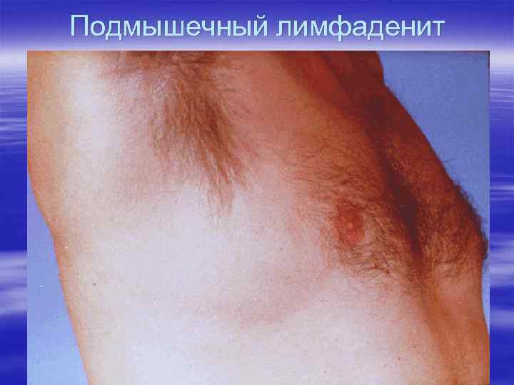 Подмышечный лимфаденит 