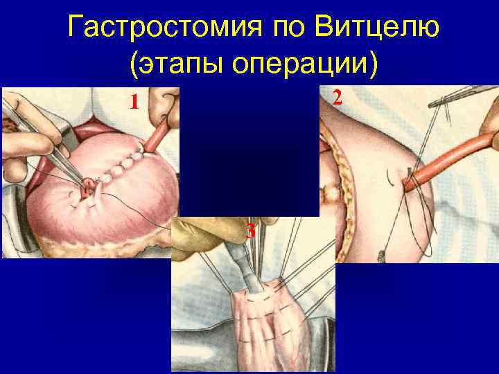 Гастростомия по Витцелю (этапы операции) 2 1 3 