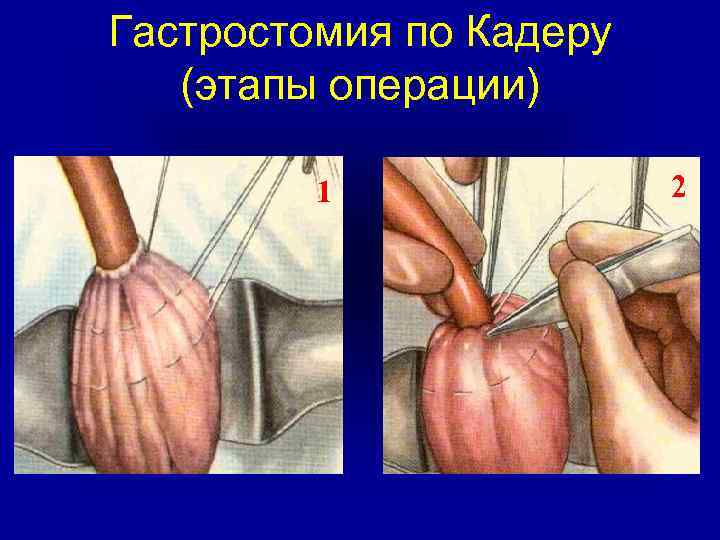 Гастростомия по Кадеру (этапы операции) 1 2 