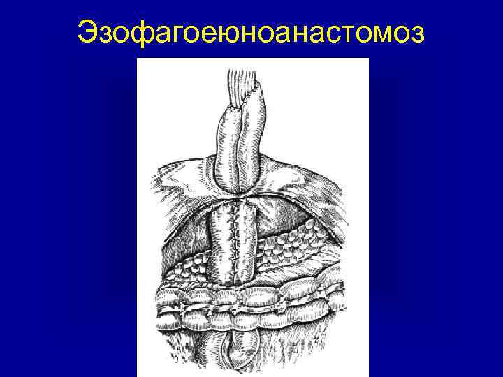 Эзофагоеюноанастомоз 
