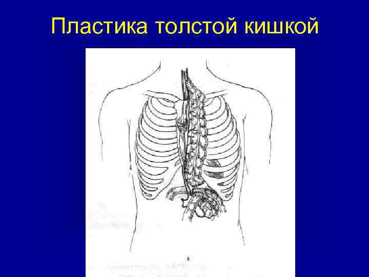 Пластика толстой кишкой 