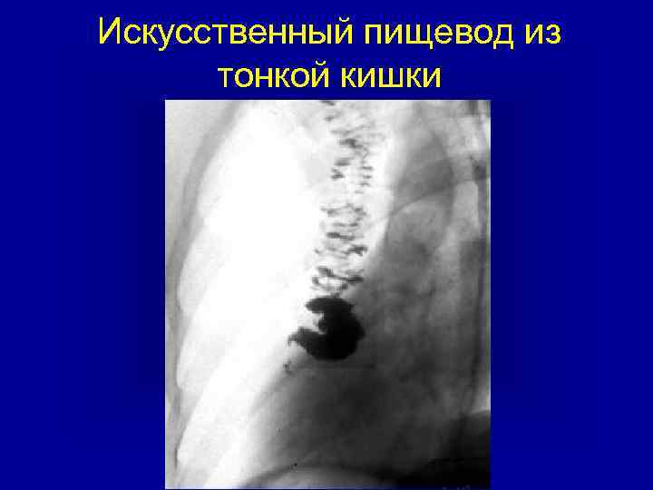 Искусственный пищевод из тонкой кишки 