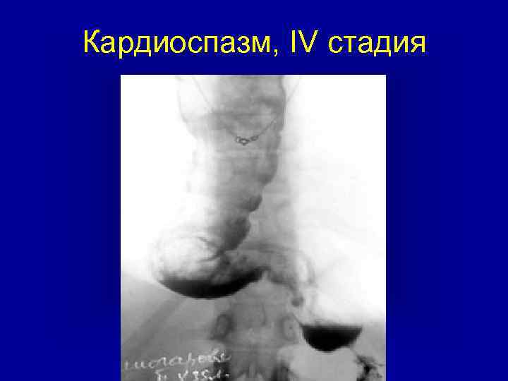 Кардиоспазм, IV стадия 
