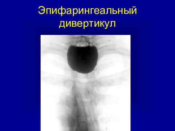 Эпифарингеальный дивертикул 
