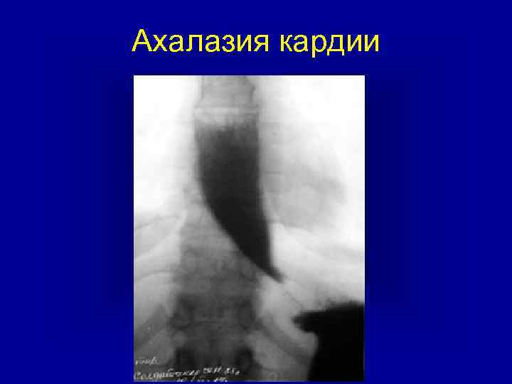 Ахалазия кардии пищевода