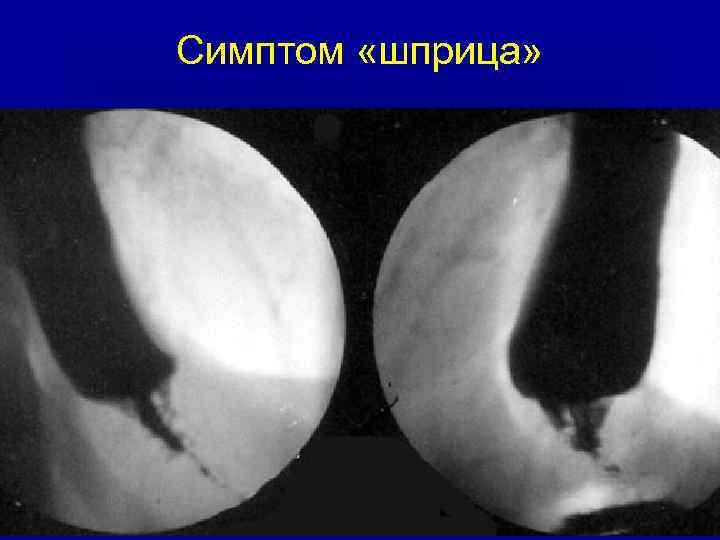 Симптом «шприца» 