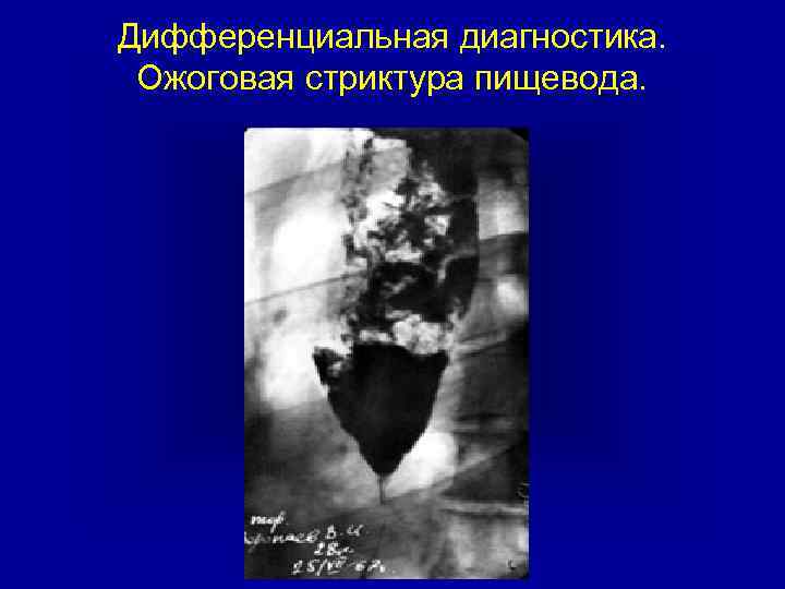 Дифференциальная диагностика. Ожоговая стриктура пищевода. 