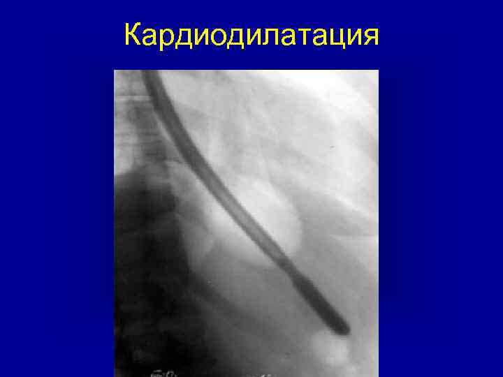 Кардиодилатация 
