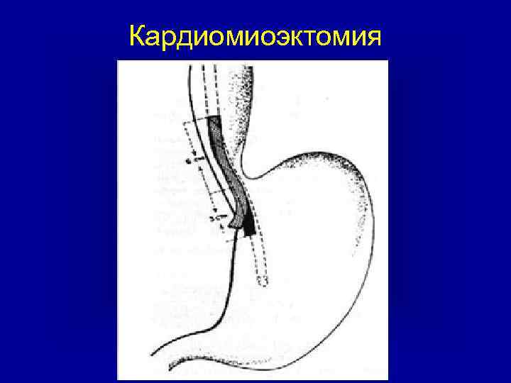 Кардиомиоэктомия 