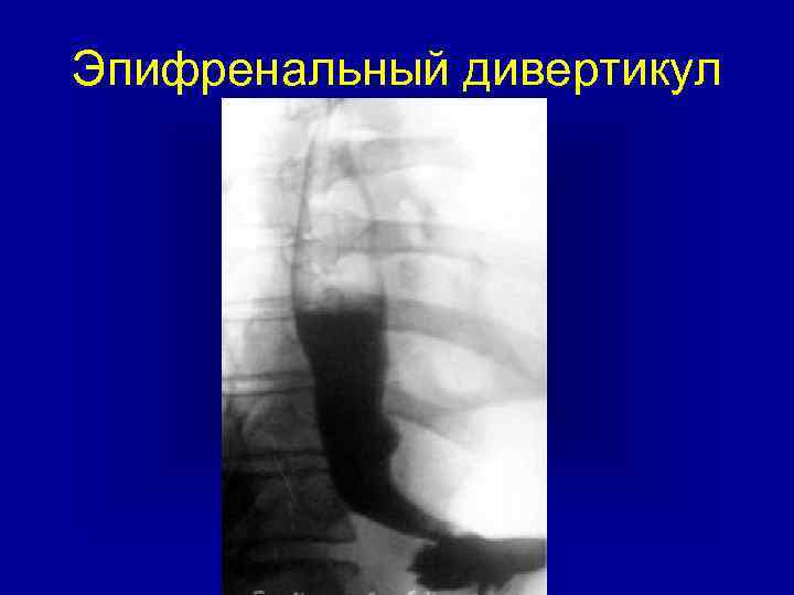 Эпифренальный дивертикул 