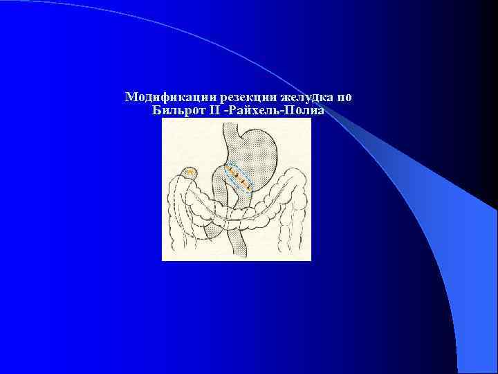 Резекция желудка по витебскому схема операции