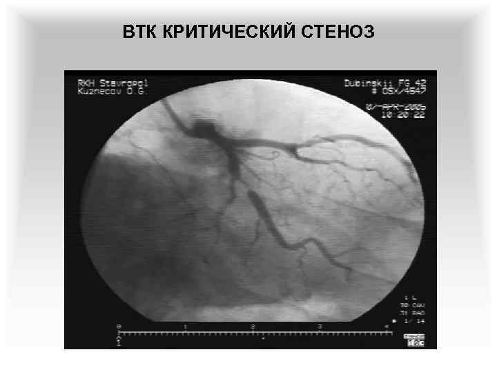 ВТК КРИТИЧЕСКИЙ СТЕНОЗ 