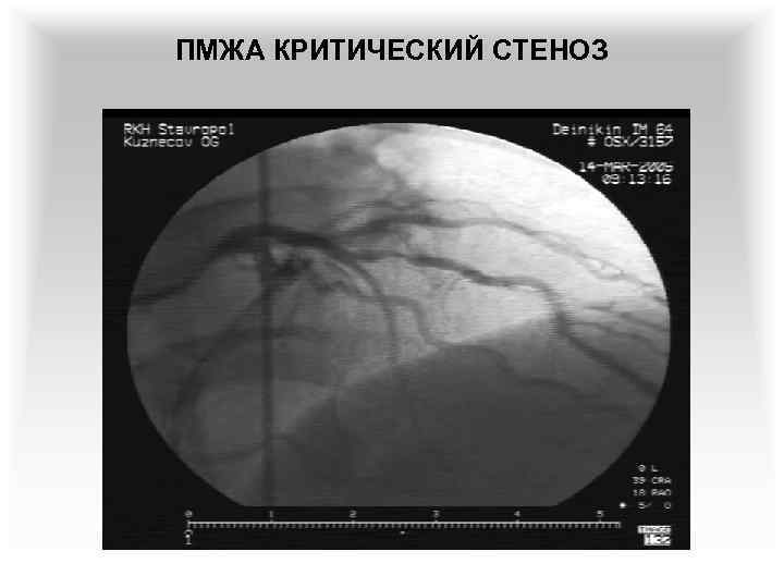 ПМЖА КРИТИЧЕСКИЙ СТЕНОЗ 